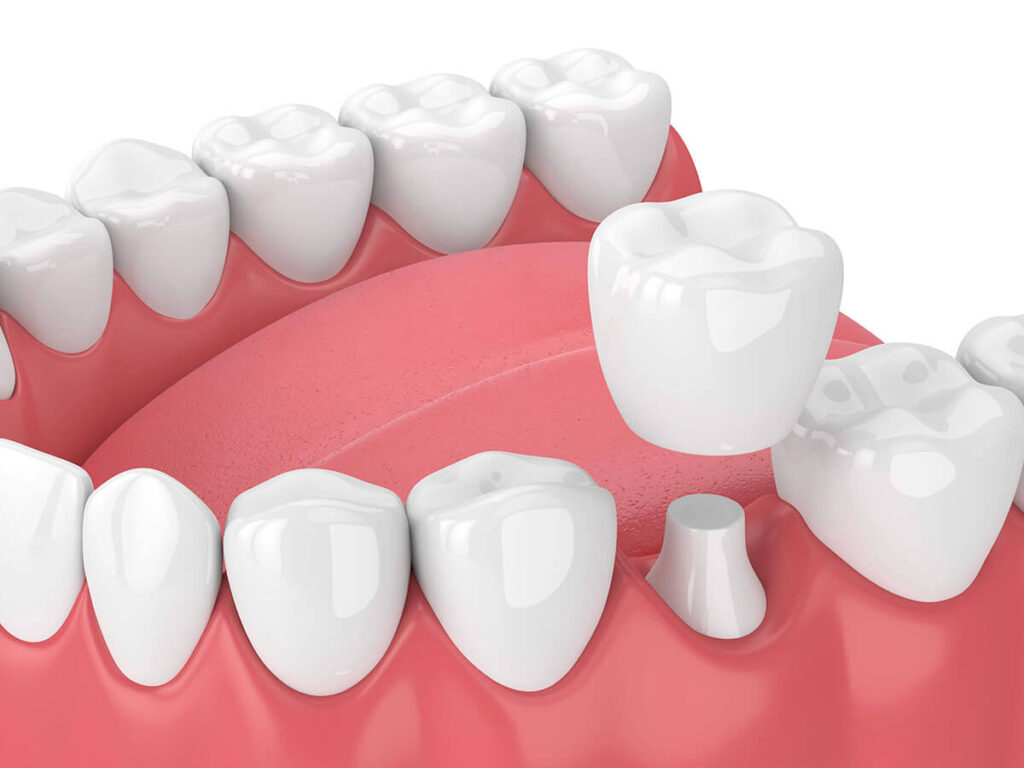 3D illustration of a lower jaw with dental crown, depicting a dental restoration process with one tooth prepared for crown placement, set against a white and pink background