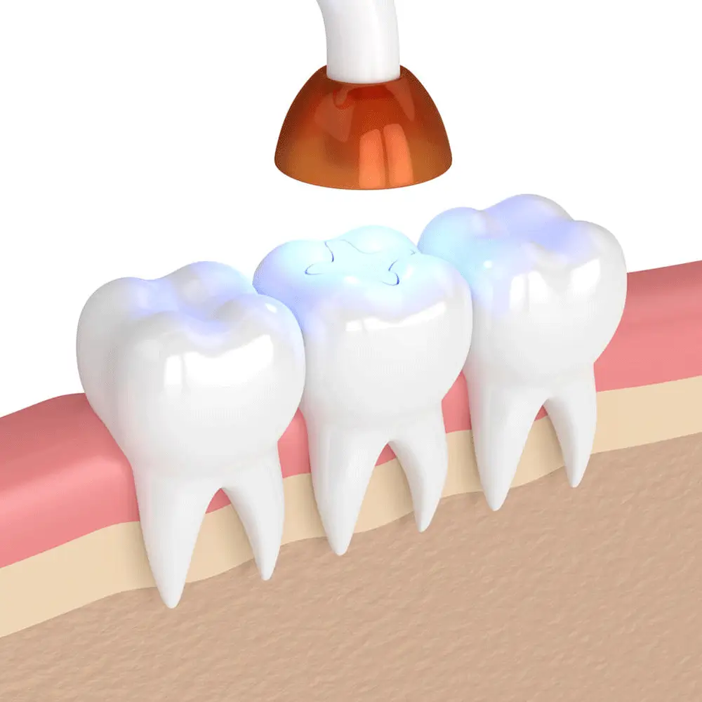 illustration of a blue light over a cavity filling to seal the filling